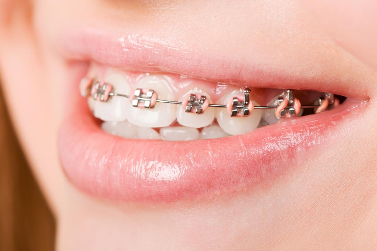 Ortodonzia estetica con attacchi in ceramica