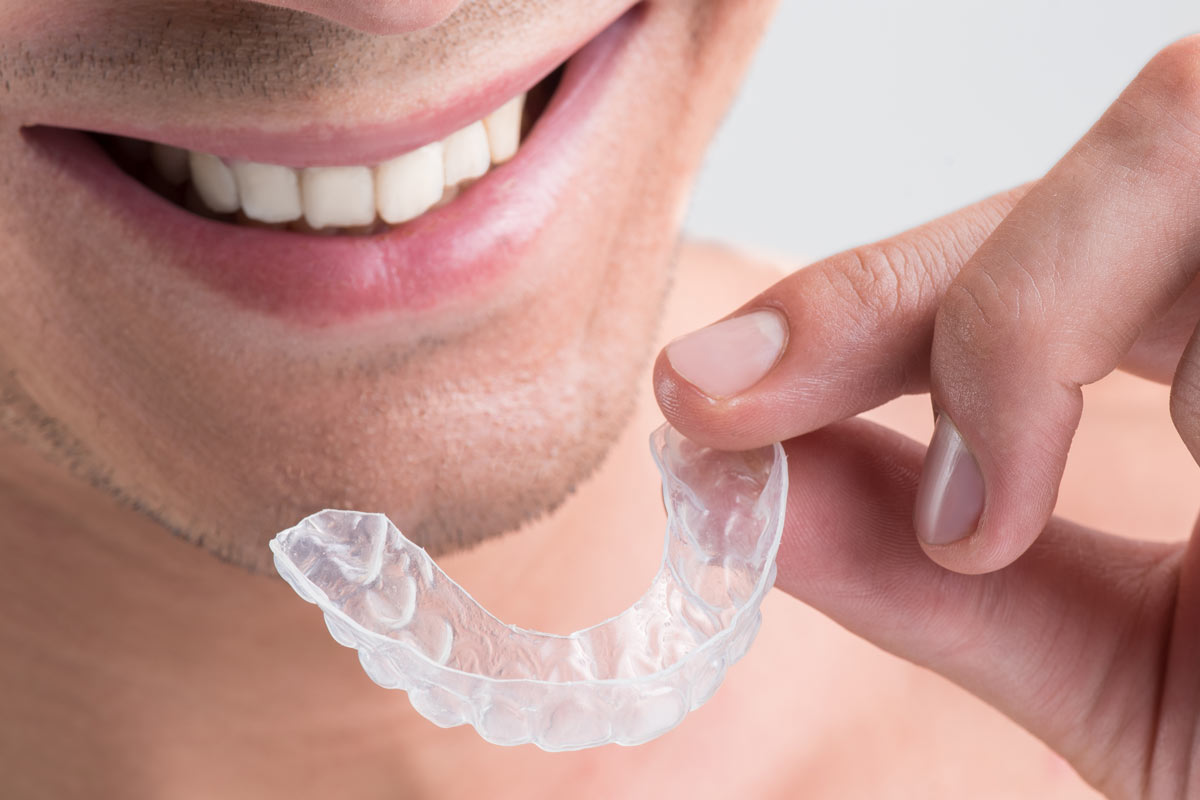 Ortodonzia invisibile con la tecnica invisalign uomo
